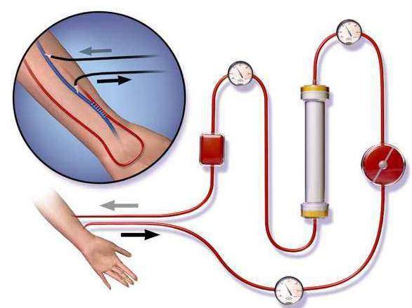 血液透析器端蓋專用塑料，你找對生產廠家了嗎？